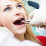 Wisdom Teeth Extraction Oral Surgery Los Angeles