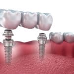 Tooth implants