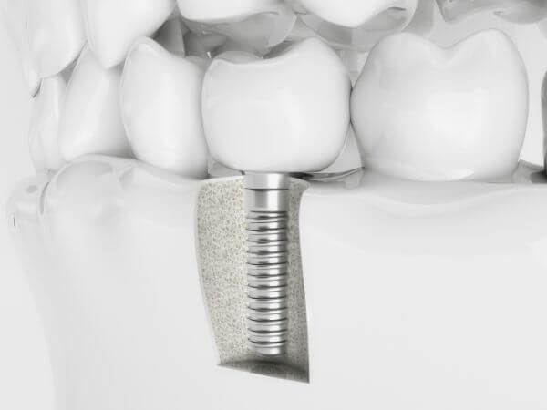 stage-one-dental-implants