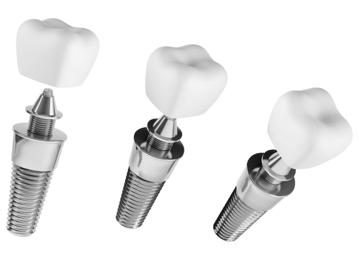stages-of-dental-implants